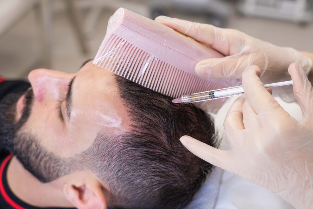 PRP hair treatment in Dubai