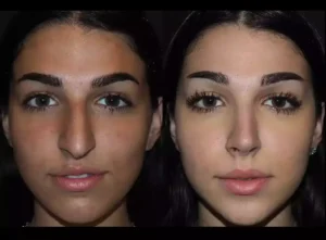 septoplasty in dubai