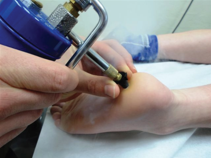 how effective is cryotherapy for warts?