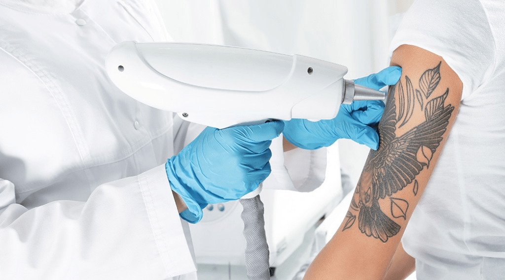 Laser Tattoo Removal in Dubai