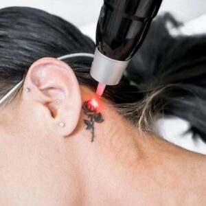 Tattoo Removal in Islamabad