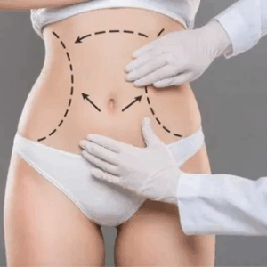 Tummy Tuck in Islamabad