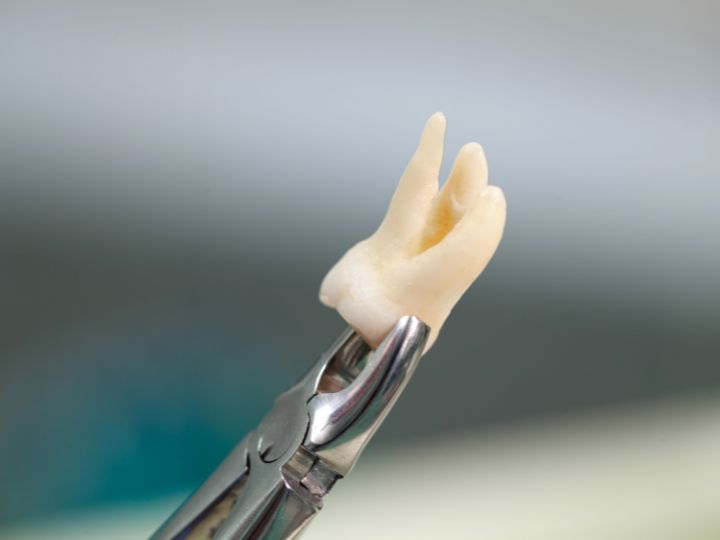tooth extraction cost