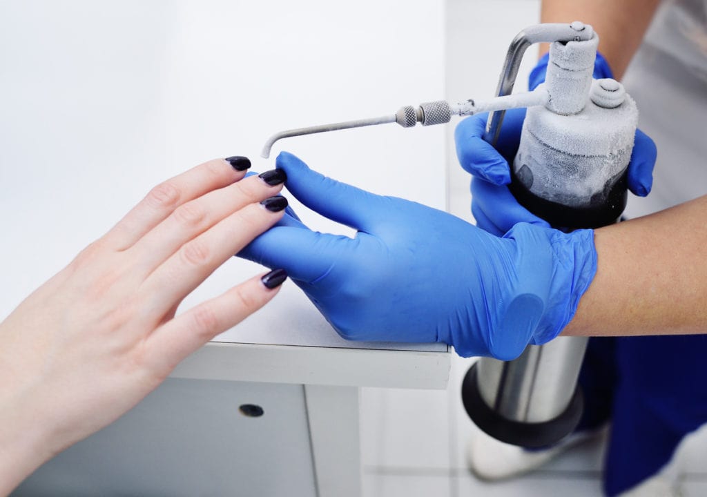 How Cryotherapy Helps You Quickly Eliminate Warts and Achieve Clear Skin
