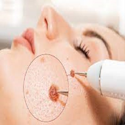 Warts Removal Treatment
