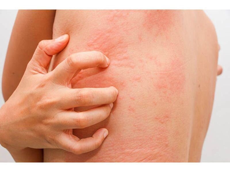 What Are the Best Treatments for Eczema in Dubai’s Dry Climate
