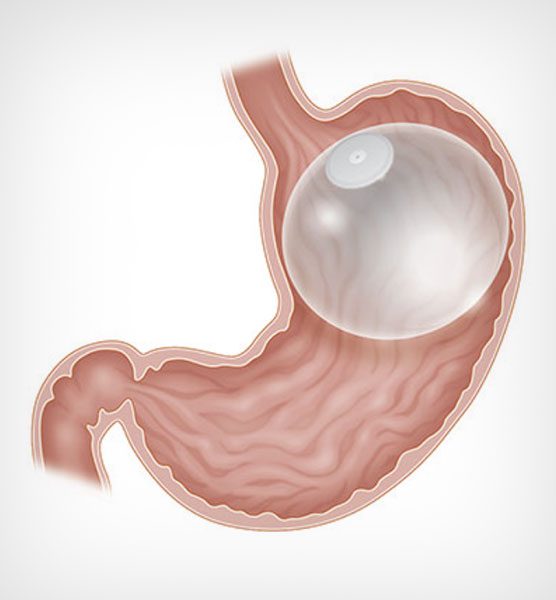 What Are the Potential Side Effects of a Gastric Balloon in Dubai and How Can You Manage Them