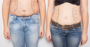 Obesity treatment Dubai