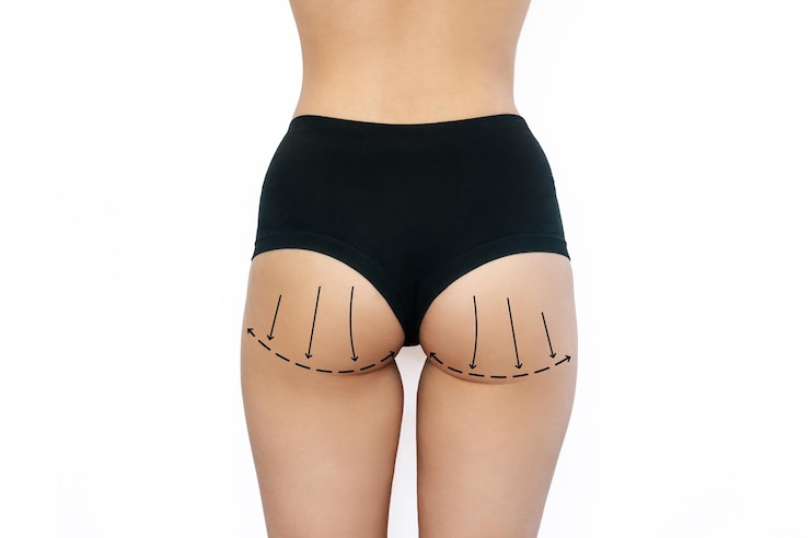 What Makes Brazilian Butt Lift Popular