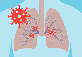 Can Parasitic Infections Affect COVID-19 Severity? A Medical Insight