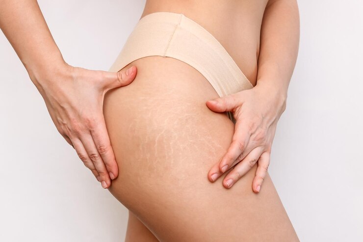 What to Expect from Stretch Mark Removal