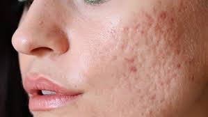 Fungal acne