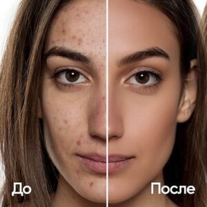 Acne Treatment In Islamabad