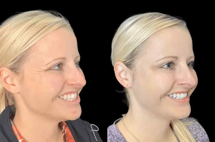 What Makes Botox in Dubai So Popular Among Influencers