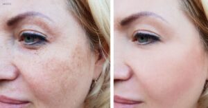 check the difference after glutathione whitening injection treatment