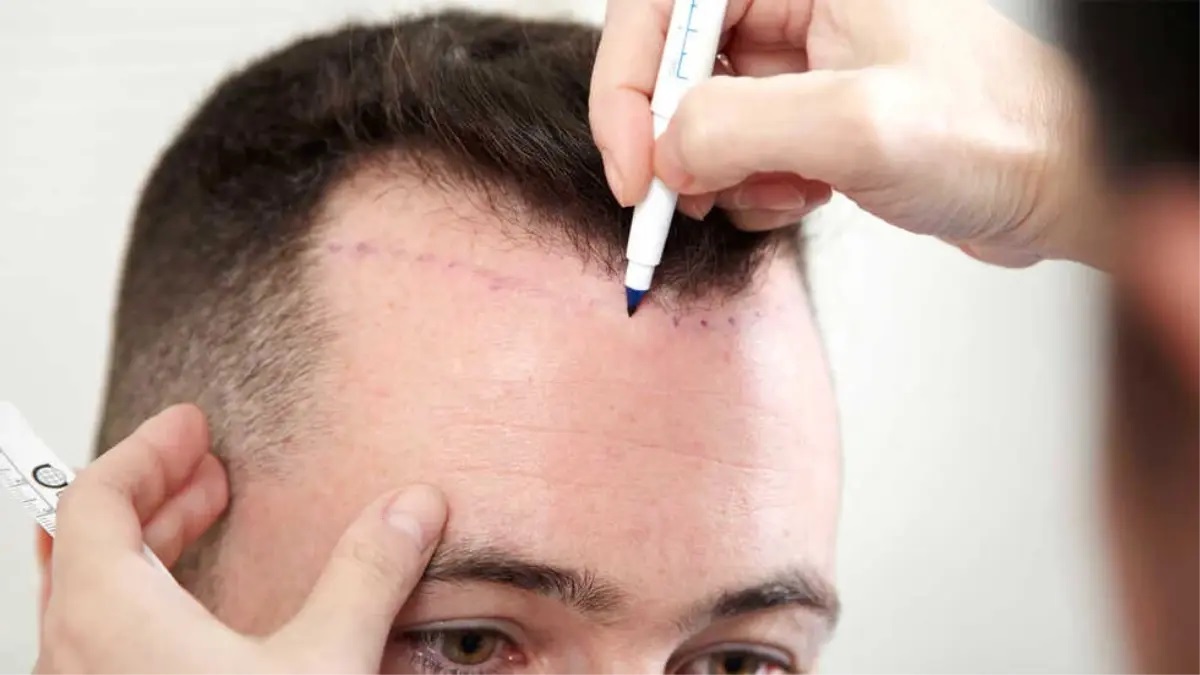 زراعة الشعر