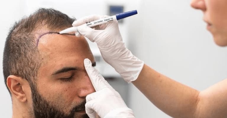 زراعة الشعر في الإمارات العربية المتحدة