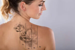 laser tattoo removal in Islamabad