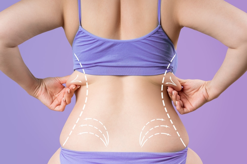 Laser liposuction in Dubai