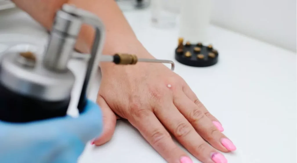 Effective Wart Treatment with Cryotherapy: A Natural, Safe Approach