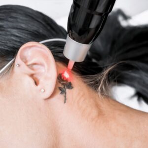 laser skin resurfacing bradenton fl