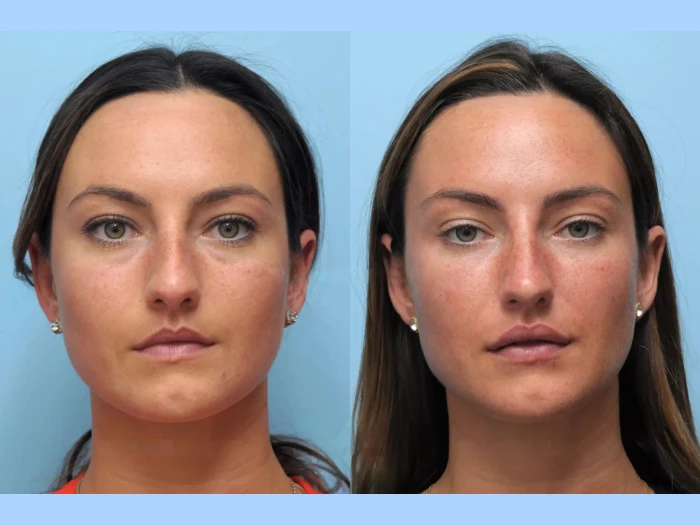 Why More Clients Are Opting for Thread Lift Treatment in Dubai