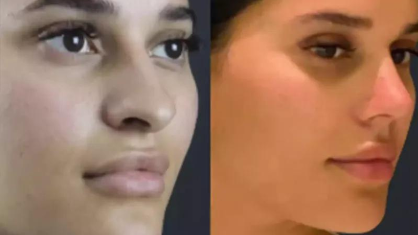septoplasty in dubai