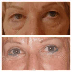 Eye Bag Removal