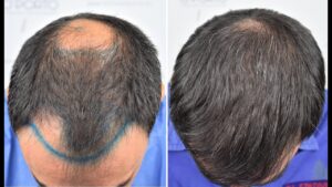 Crown hair transplant in Islamabad