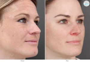 Does microneedling help with melasma?