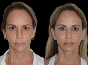 Chin Fillers Injections in Dubai