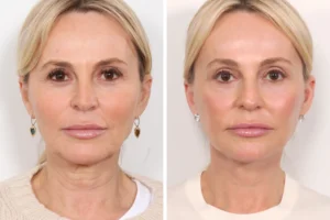 How the Best Plastic Surgeons in Dubai Perform Non-Surgical Thread Lifts