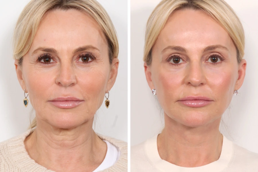 How the Best Plastic Surgeons in Dubai Perform Non-Surgical Thread Lifts
