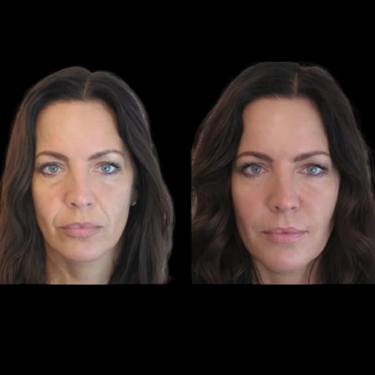 Jawline Fillers Injections in Dubai