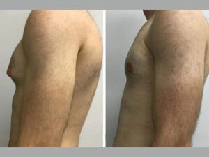 gynecomastia in dubai