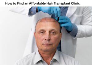 How to Find an Affordable Hair Transplant Clinic