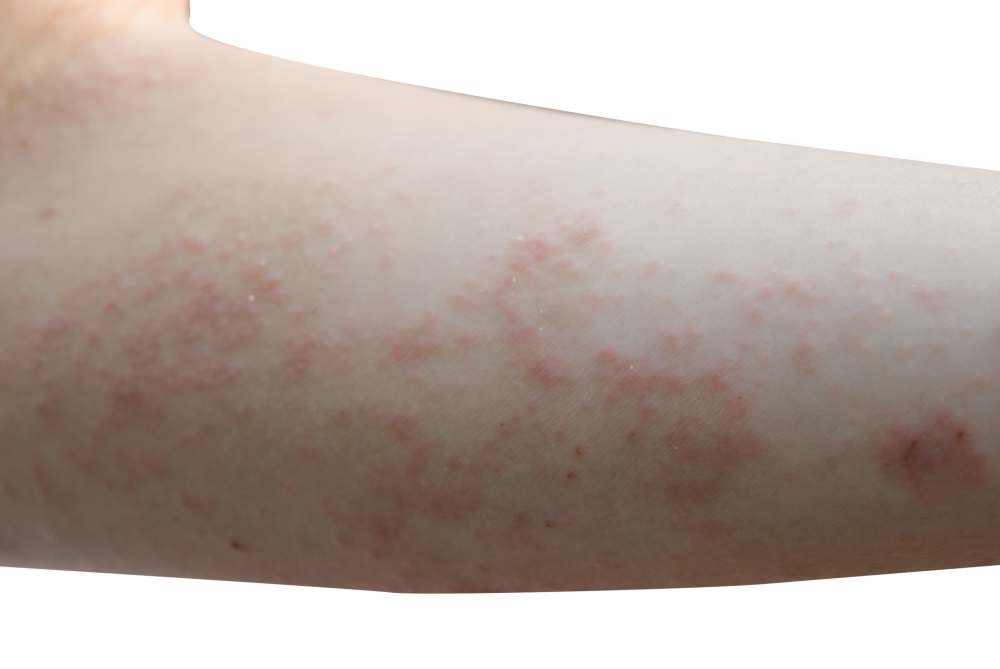 How Long Does It Take for Ivermectin to Kill Scabies?