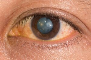 cost for eye laser treatment