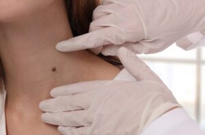 Live Sweat Free with Hyperhidrosis Treatments