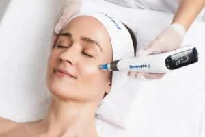 Does microneedling help with melasma?