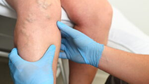 Non-Surgical Solutions for Spider Veins