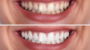 Sparkling Confidence with Teeth Whitening in Lahore