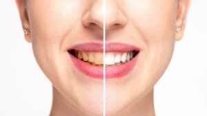 Sparkling Confidence with Teeth Whitening in Lahore