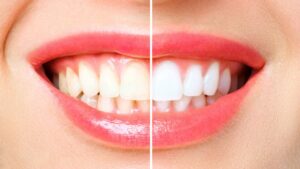 Sparkling Confidence with Teeth Whitening in Lahore
