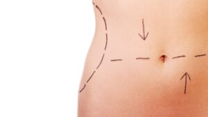 Tummy Tuck in Islamabad