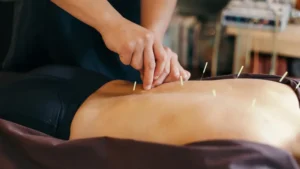 acupuncture to lose weight