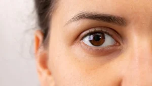 The Science Behind Dark Circles — And the Real Cure