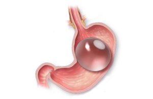 Gastric Balloon Placement in Dubai