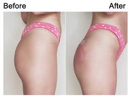 butt injections vs. BBL