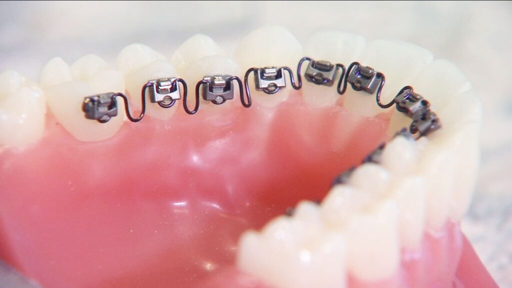 what is the best age for teeth braces?